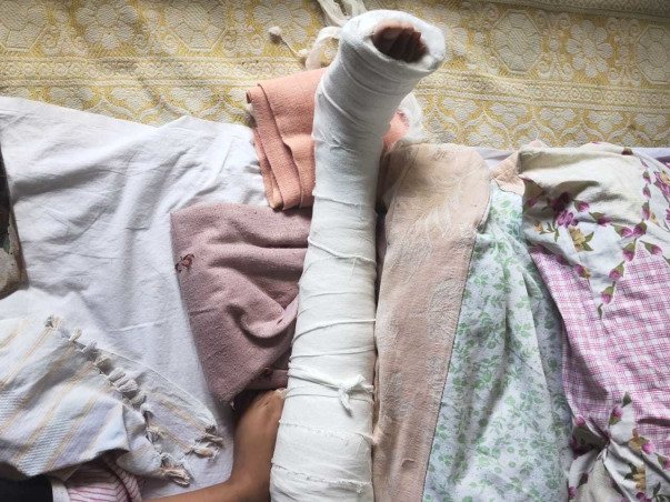 Support Sanjay Recover From Osteogenesis Imperfecta