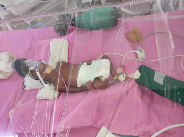 Please Help My Sister's Preterm Birth Twins Girl Babies