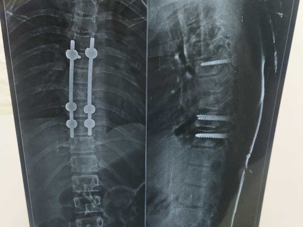 Help My Brother Recover From Multiple Fractures, Paralysis, Liver And Spinal Cord Damage