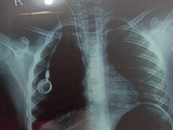 Help Deekshitha Aged 6 To Fight Against Bone Cancer