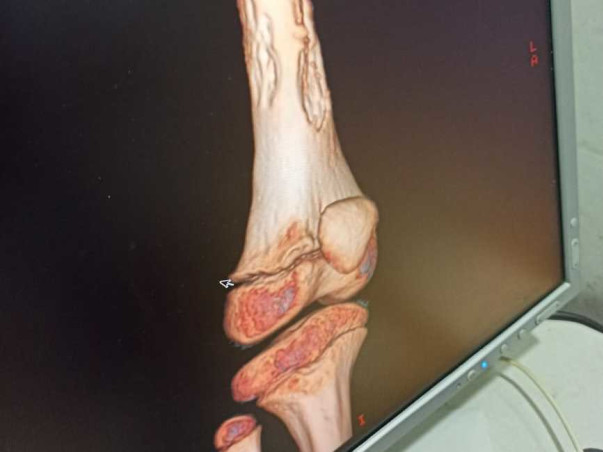 Help Deekshitha Aged 6 To Fight Against Bone Cancer