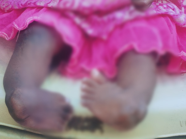 Support Samuktha To Undergo Leg Surgery