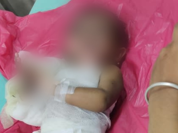 Support Dhanika Recover From Accidental Fire Burn