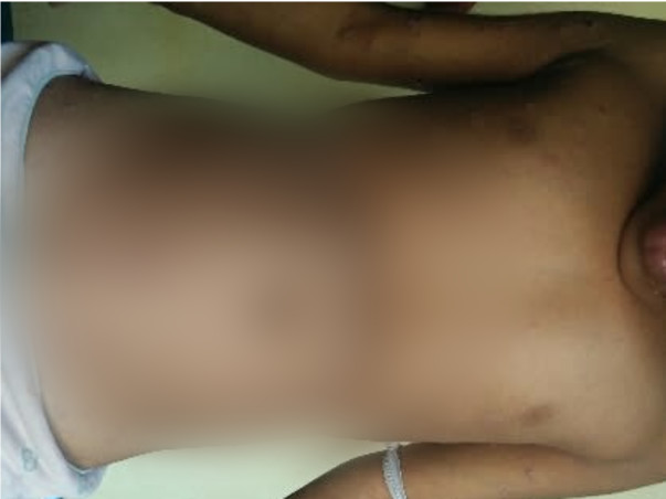 Help My Daughter Monika 7 yrs/O, Recover Skin Infection