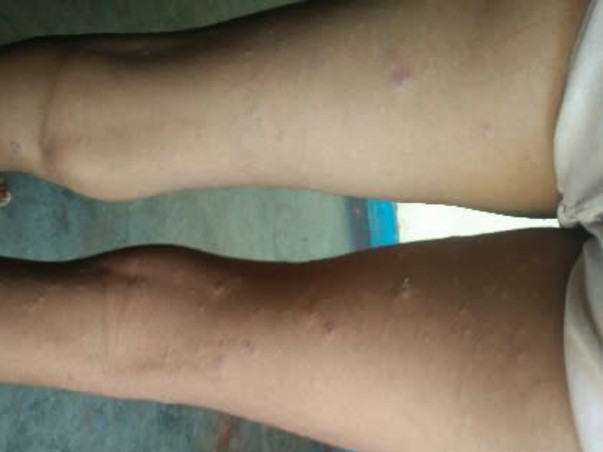 Help My Daughter Monika 7 yrs/O, Recover Skin Infection