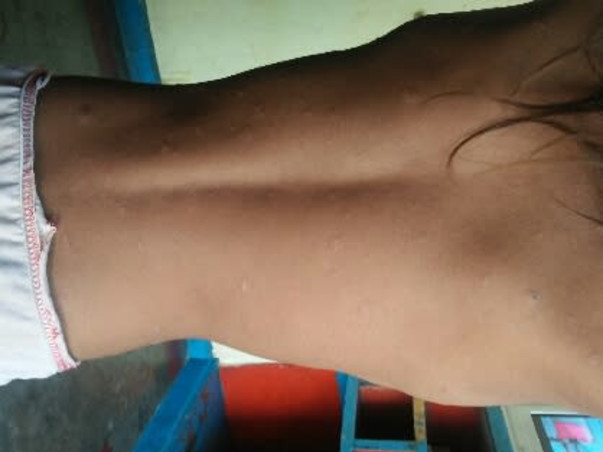 Help My Daughter Monika 7 yrs/O, Recover Skin Infection