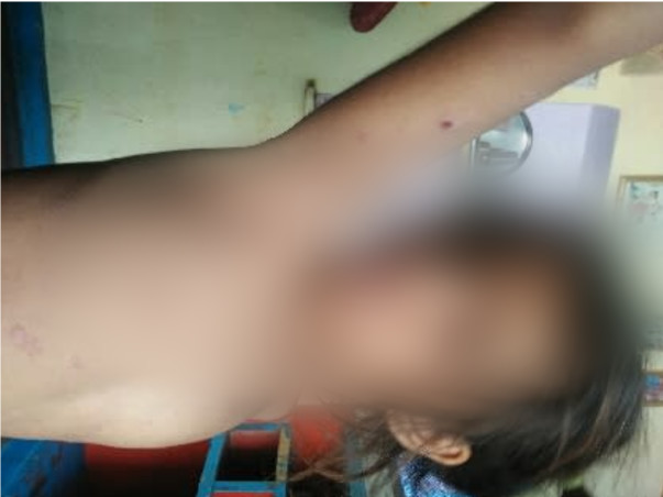 Help My Daughter Monika 7 yrs/O, Recover Skin Infection