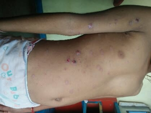 Help My Daughter Monika 7 yrs/O, Recover Skin Infection