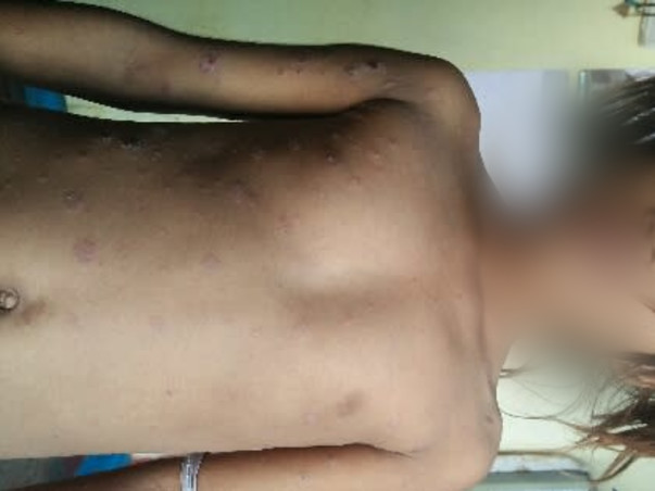 Help My Daughter Monika 7 yrs/O, Recover Skin Infection