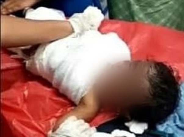 Support Dhanika Recover From Accidental Fire Burn