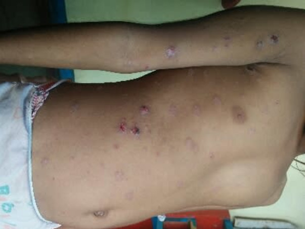 Help My Daughter Monika 7 yrs/O, Recover Skin Infection