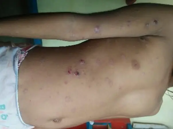 Help My Daughter Monika 7 yrs/O, Recover Skin Infection