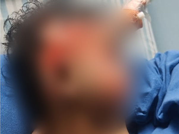 Support Dhanika Recover From Accidental Fire Burn