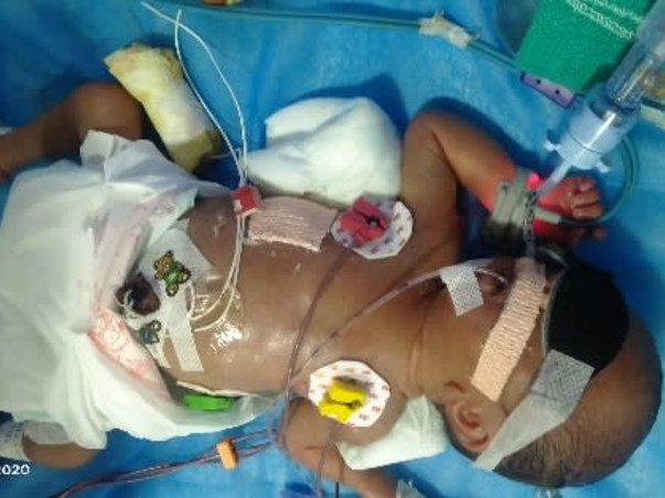 Support My Baby To Recover From Premature Birth