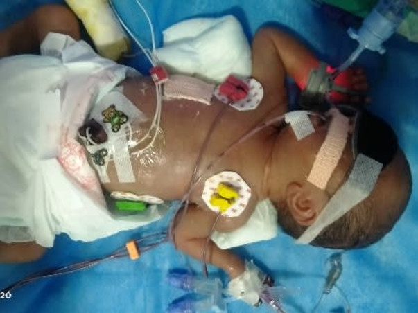 Support My Baby To Recover From Premature Birth