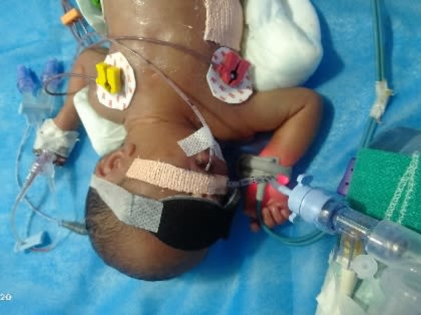 Support My Baby To Recover From Premature Birth