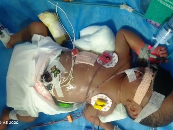 Support My Baby To Recover From Premature Birth