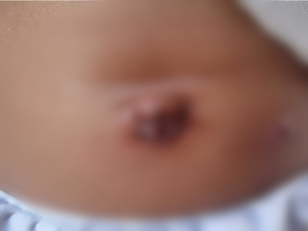 Please Support Humera To Recover From umbilical Hernia