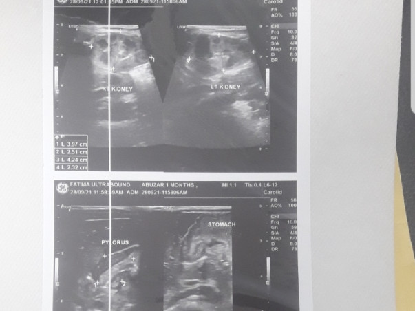 Help 1-month-old Master Abuzar Recover From Pyloric Stenosis