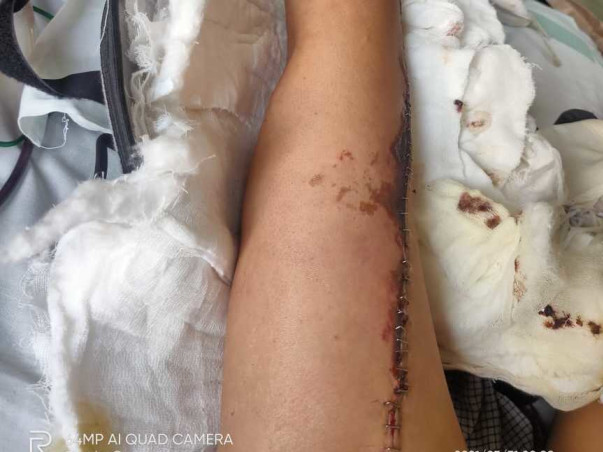 Support Jaydeep Manoj Bhai Pandit Recover From Bone Cancer