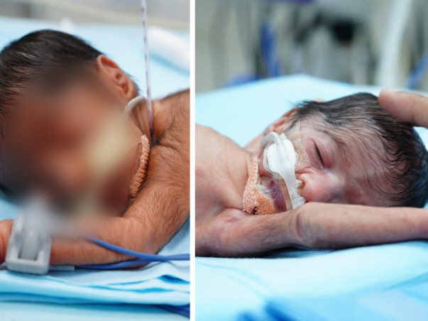 Support Babies Of Akhila  To Recover From  Preterm Birth