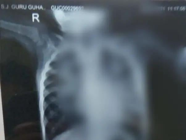 Support 2 Year Old Guru Guhn Undergo Cardiac Surgery