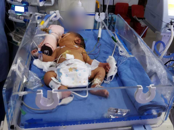 10 days old syed ali needs your help fight Lung infection, Dextrocardia (right side heart), his father is a poor man and works as a scooter mechanic