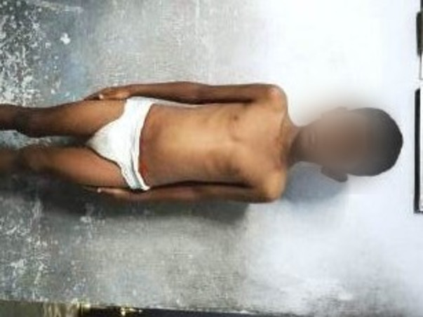 NEEDED HELP FOR MY SON SURGERY (EXSTROPHY BLADDER)