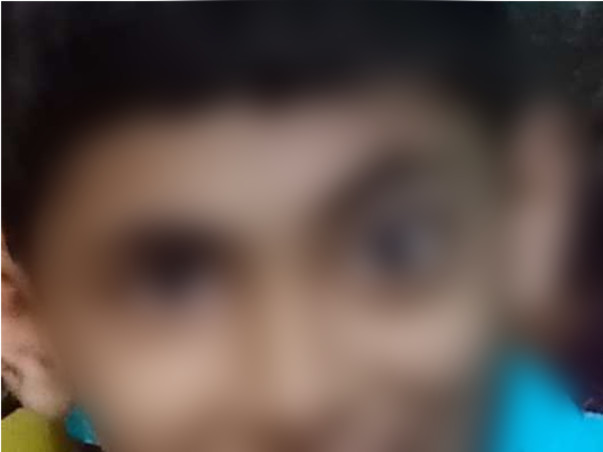 Help Adil Fight Orbital (Eye) Bony Lesion (Tumor)