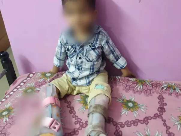 2 Years Old Aahil Iyad Needs Your Help To Recover From Bilateral Congenital Pseudarthrosis Of Tibia