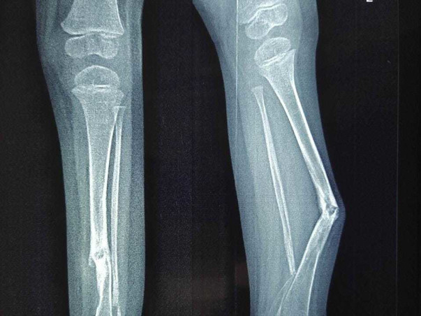 2 Years Old Aahil Iyad Needs Your Help To Recover From Bilateral Congenital Pseudarthrosis Of Tibia