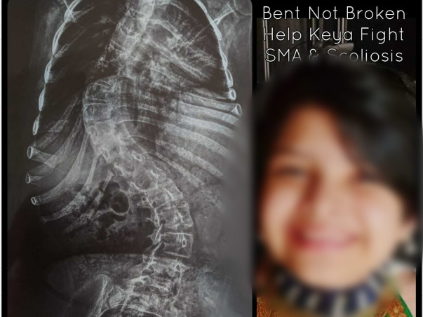 Help Keya Fight Spinal Muscular Atrophy (SMA Type 2)