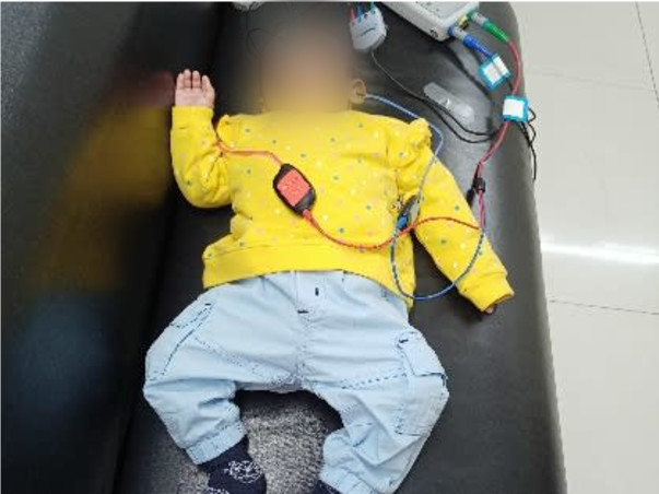 Brain Infection due to CMV