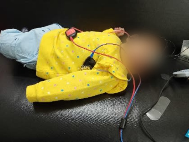 Brain Infection due to CMV