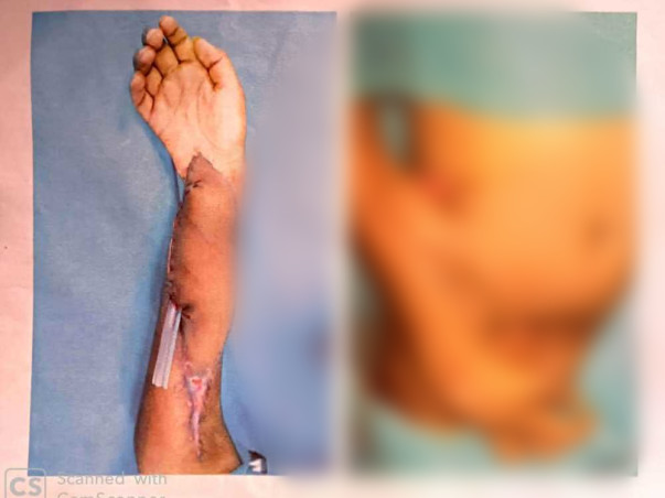 Help Surya a 16 Year Old Restore His Hands & His Life