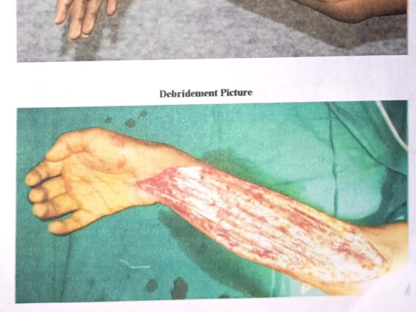 Help Surya a 16 Year Old Restore His Hands & His Life