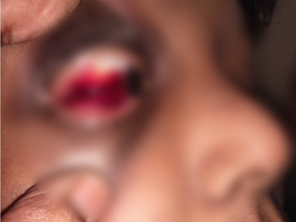 Fundraiser for 10 yr old boy suffering with Hemophilia(blood bleeding)