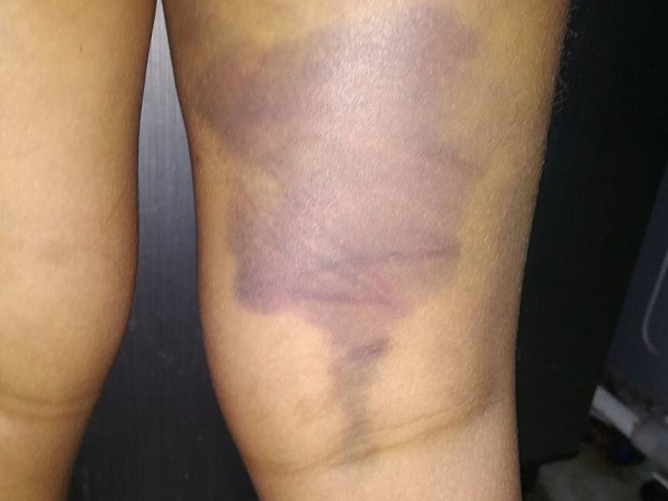 Fundraiser for 10 yr old boy suffering with Hemophilia(blood bleeding)