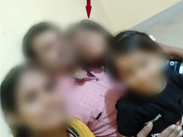 8 Years Old Brunda Needs Your Help to Fight Severe Burns