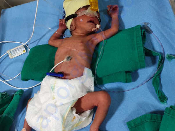 Help my 32 week premature baby girl twins