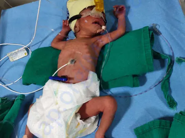 Help my 32 week premature baby girl twins