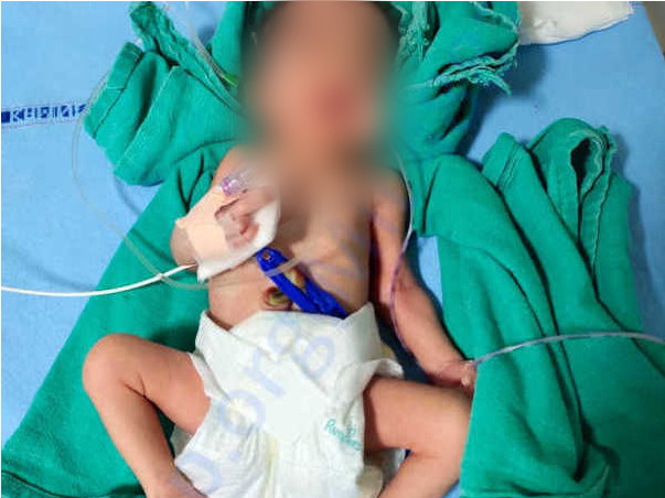 Help my 32 week premature baby girl twins