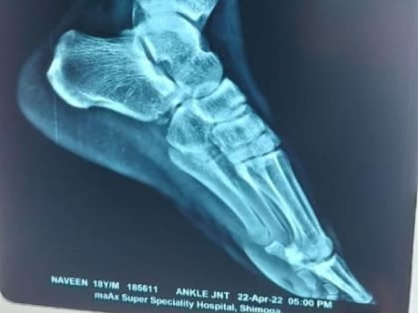 Help Naveen To Walk Again As He Met With Severe Leg Accident