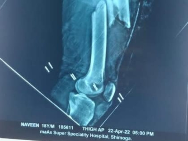 Help Naveen To Walk Again As He Met With Severe Leg Accident