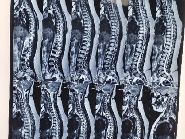 Support Yashaswi Sagarika To Undergo Spinal Cord Surgery