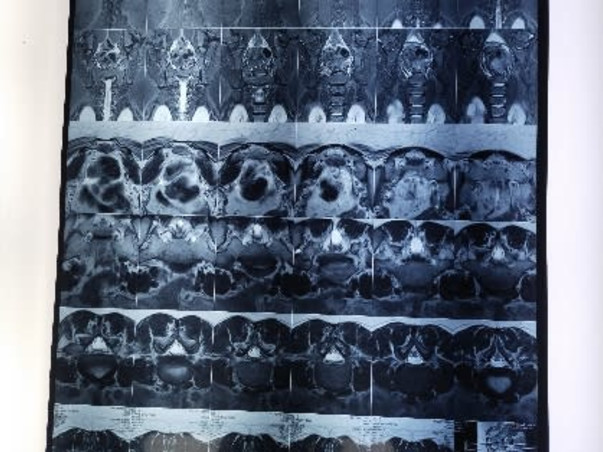 Support Yashaswi Sagarika To Undergo Spinal Cord Surgery