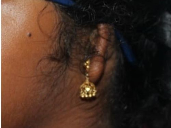 Help Manaswini To Get Rid Of Her Disability