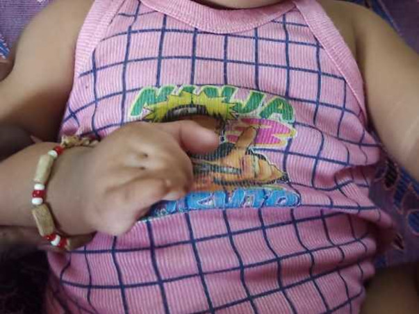 Help 8 Month Old Vishnu Priyan To Recover from Physical Disability