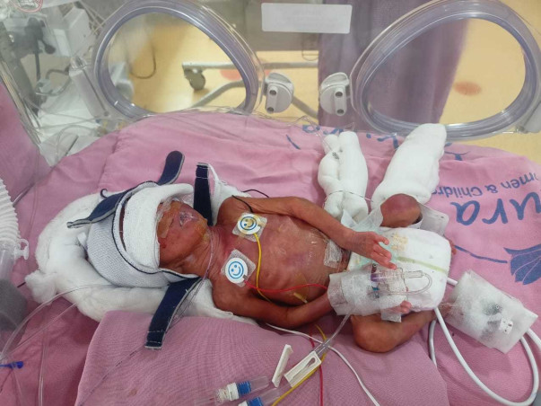 My Baby Needs Your Help To Survive Premature Birth Complications