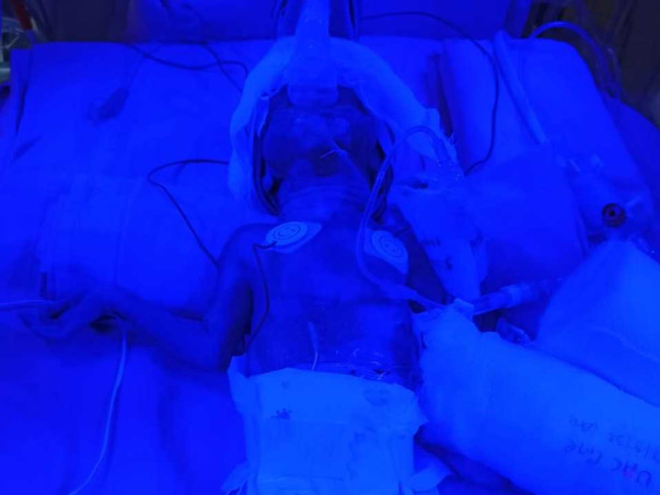 My Baby Needs Your Help To Survive Premature Birth Complications